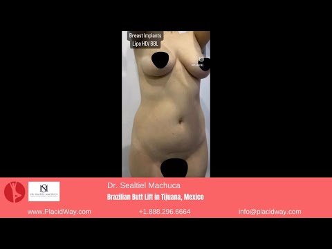 Transforming Curves with Brazilian Butt Lift by Dr. Sealtiel Machuca in Tijuana, Mexico